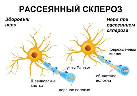 рассеянный склероз передается по наследству|Рассеянный склероз: симптомы, причины,。